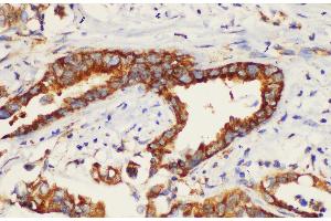 Immunohistochemistry of paraffin-embedded Human pancreatic cancer using K1KB3 Ployclonal Antibody at dilution of 1:200. (KLK1B3 抗体)