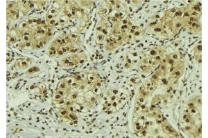 ABIN6267118 at 1/100 staining Human breast cancer tissue by IHC-P.