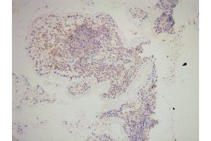 SNAI2 Antibody(ABIN6276471) staining human cervical carcinoma tissue sections by IHC-f at 1:200. (SLUG 抗体  (Internal Region))