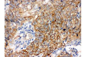 Anti- Bag3 Picoband antibody, IHC(P) IHC(P): Human Lung Cancer Tissue (BAG3 抗体  (AA 100-561))