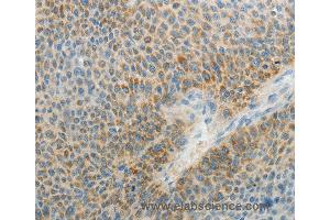 Immunohistochemistry of Human liver cancer using AGAP1 Polyclonal Antibody at dilution of 1:25