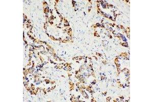 Anti-Paxillin antibody, IHC(P) IHC(P): Human Lung Cancer Tissue (Paxillin 抗体  (C-Term))