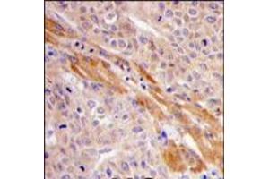 Formalin-fixed and paraffin-embedded human hepatocarcinoma tissue reacted with PGK1 Antibody (Center), which was peroxidase-conjugated to the secondary antibody, followed by DAB staining. (PGK1 抗体  (Middle Region))