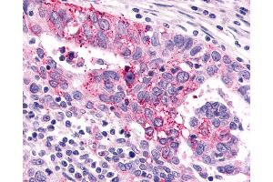 Anti-GRM6 / MGLUR6 antibody IHC of human Ovary, Carcinoma. (Metabotropic Glutamate Receptor 6 抗体  (N-Term))