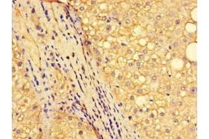 Immunohistochemistry of paraffin-embedded human liver cancer using ABIN7161893 at dilution of 1:100 (NR1D1 抗体  (AA 246-558))