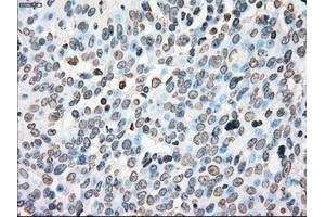 Immunohistochemical staining of paraffin-embedded Adenocarcinoma of colon tissue using anti-PLK1mouse monoclonal antibody. (PLK1 抗体)