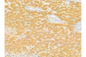 ABIN6259381 and ABIN6276145 at 1/100 staining human hepatocellular carcinoma by IHC-P.