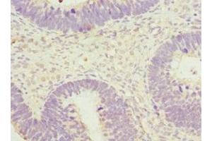 Immunohistochemistry of paraffin-embedded human ovarian cancer using ABIN7170599 at dilution of 1:100 (Spindlin 1 抗体  (AA 1-262))