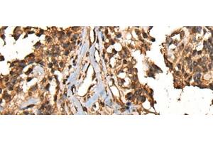 Immunohistochemistry of paraffin-embedded Human ovarian cancer tissue using CAMKK1 Polyclonal Antibody at dilution of 1:35(x200) (CAMKK1 抗体)