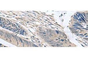 Immunohistochemistry of paraffin-embedded Human colorectal cancer tissue using NPHP1 Polyclonal Antibody at dilution of 1:60(x200) (NPHP1 抗体)