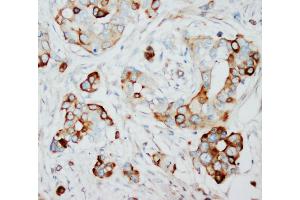Anti-SKP2 antibody, IHC(P) IHC(P): Human Mammary Cancer Tissue (SKP2 抗体  (N-Term))
