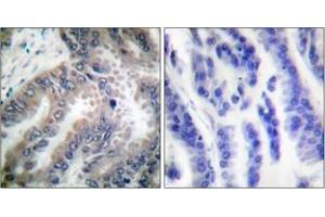 Immunohistochemistry analysis of paraffin-embedded human lung carcinoma tissue, using Caspase 8 (Ab-347) Antibody. (Caspase 8 抗体  (AA 313-362))