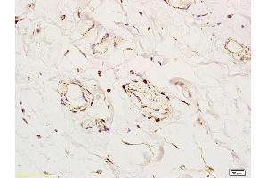 Formalin-fixed and paraffin embedded human colon tissue labeled with Anti-Angiomotin Polyclonal Antibody, Unconjugated (ABIN754873) at 1:200 followed by conjugation to the secondary antibody and DAB staining (Angiomotin 抗体  (AA 545-620))