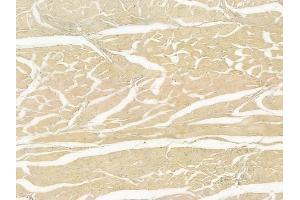 ABIN6266279 and ABIN6277274 at 1/100 staining human tongue carcinoma by IHC-P. (TGFBI 抗体  (N-Term))