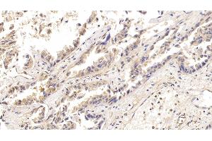 Detection of ACO1 in Human Lung cancer Tissue using Polyclonal Antibody to Aconitase 1 (ACO1) (Aconitase 1 抗体  (AA 26-243))