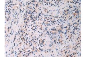 Detection of FBLN1 in Human Prostate cancer Tissue using Polyclonal Antibody to Fibulin 1 (FBLN1) (Fibulin 1 抗体  (AA 176-398))