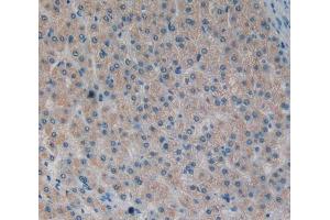 IHC-P analysis of liver cancer tissue, with DAB staining. (MOK 抗体  (AA 173-418))