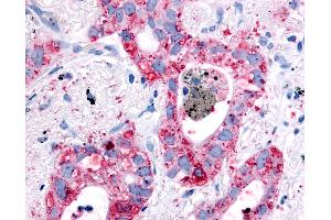 Anti-EGFR antibody IHC of human Lung, Non-Small Cell Carcinoma. (EGFR 抗体)