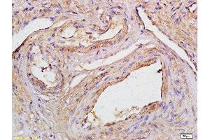 Formalin-fixed and paraffin embedded human cervical carcinoma labeled with Anti-CCDC90A Polyclonal Antibody, Unconjugated  at 1:200 followed by conjugation to the secondary antibody (CCDC90A 抗体  (AA 261-359))
