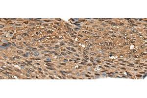 Immunohistochemistry of paraffin-embedded Human esophagus cancer tissue using CALML5 Polyclonal Antibody at dilution of 1:70(x200) (CALML5 抗体)