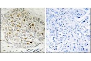 Immunohistochemistry analysis of paraffin-embedded human breast carcinoma tissue, using HDAC5 (Ab-498) Antibody. (HDAC5 抗体  (AA 464-513))