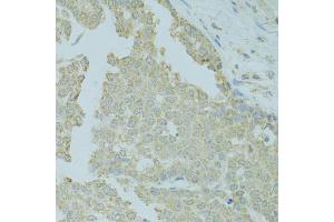 Immunohistochemistry of paraffin-embedded human colon carcinoma using MTFP1 antibody (ABIN5975088) at dilution of 1/100 (40x lens). (Mtfp1 抗体)