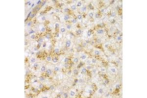 Immunohistochemistry of paraffin-embedded human liver cancer using ACTN1 antibody at dilution of 1:100 (400x lens). (ACTN1 抗体)