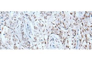 Immunohistochemistry of paraffin-embedded Human lung cancer tissue using BRD3 Polyclonal Antibody at dilution of 1:60(x200) (BRD3 抗体)