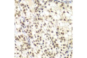 Immunohistochemistry of paraffin-embedded human kidney cancer using UHRF2 antibody (ABIN6133264, ABIN6149911, ABIN6149913 and ABIN6217665) at dilution of 1:200 (40x lens). (UHRF2 抗体  (AA 441-622))