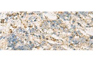 Immunohistochemistry of paraffin-embedded Human cervical cancer tissue using VTA1 Polyclonal Antibody at dilution of 1:60(x200) (VTA1 抗体)