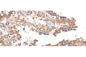 Immunohistochemistry of paraffin-embedded Human ovarian cancer tissue using MTNR1B Polyclonal Antibody at dilution of 1:55(x200) (Melatonin Receptor 1B 抗体)