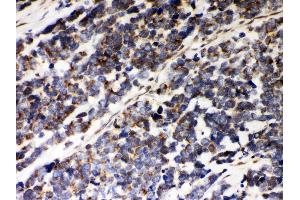 Anti- Peroxiredoxin 5 Picoband antibody, IHC(P) IHC(P): Human Lung Cancer Tissue (Peroxiredoxin 5 抗体  (AA 66-198))
