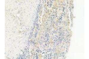 ABIN6257807 and ABIN6275264 at 1/100 staining human lung squamous cell carcinoma by IHC-P.