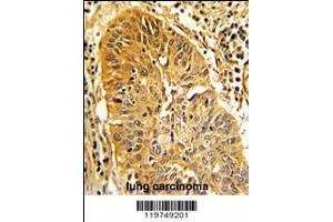 Formalin-fixed and paraffin-embedded human lung carcinoma with CALD1 Antibody , which was peroxidase-conjugated to the secondary antibody, followed by DAB staining. (Caldesmon 抗体  (AA 428-457))