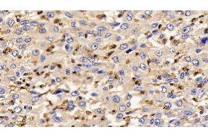 Detection of IL13Ra2 in Human Liver cancer Tissue using Polyclonal Antibody to Interleukin 13 Receptor Alpha 2 (IL13Ra2) (IL13RA2 抗体  (AA 238-334))