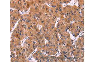 Immunohistochemistry of Human liver cancer using ERP29 Polyclonal Antibody at dilution of 1:40 (ERP29 抗体)