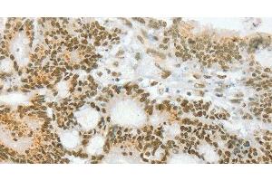Immunohistochemistry of paraffin-embedded Human colon cancer using ANGPT4 Polyclonal Antibody at dilution of 1:70 (Angiopoietin 4 抗体)