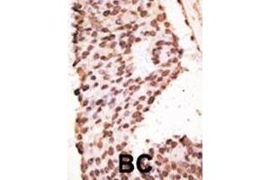 Formalin-fixed and paraffin-embedded human cancer tissue reacted with the primary antibody, which was peroxidase-conjugated to the secondary antibody, followed by AEC staining. (MMP7 抗体  (AA 117-146))