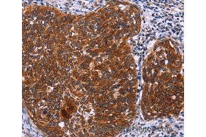 Immunohistochemistry of Human thyroid cancer using USP2 Polyclonal Antibody at dilution of 1:40 (USP2 抗体)