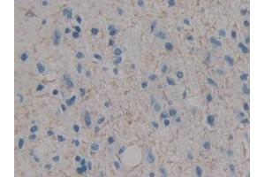 Detection of IGF1 in Human Glioma Tissue using Polyclonal Antibody to Insulin Like Growth Factor 1 (IGF1)