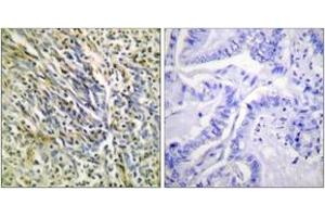 Immunohistochemistry analysis of paraffin-embedded human lung carcinoma tissue, using Aggrecan (Cleaved-Asp369) Antibody. (Aggrecan 抗体  (Cleaved-Asp369))