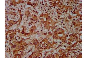 IHC image of ABIN7148760 diluted at 1:600 and staining in paraffin-embedded human liver cancer performed on a Leica BondTM system. (Cullin 7 抗体  (AA 312-450))