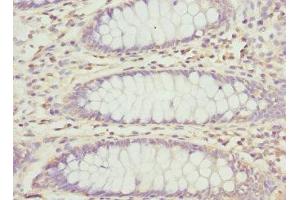 Immunohistochemistry of paraffin-embedded human colon cancer using ABIN7162995 at dilution of 1:100 (PECR 抗体  (AA 24-303))