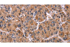 Immunohistochemistry of paraffin-embedded Human liver cancer tissue using LILRB1 Polyclonal Antibody at dilution 1:50 (LILRB1 抗体)