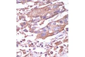 Formalin-fixed and paraffin-embedded human cancer tissue (breast carcinoma) reacted with the primary antibody, which was peroxidase-conjugated to the secondary antibody, followed by AEC staining. (CAMK2A 抗体  (C-Term))