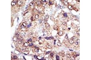 IHC analysis of FFPE human hepatocarcinoma tissue stained with the LYN antibody (LYN 抗体  (AA 32-62))