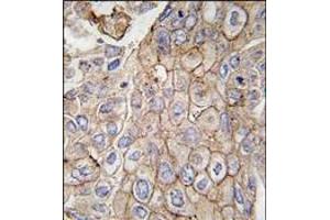 Formalin-fixed and paraffin-embedded human lung carcinoma tissue reacted with CLIC1 antibody, which was peroxidase-conjugated to the secondary antibody, followed by DAB staining.