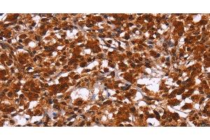 Immunohistochemistry of paraffin-embedded Human thyroid cancer tissue using HIPK1 Polyclonal Antibody at dilution 1:30 (HIPK1 抗体)