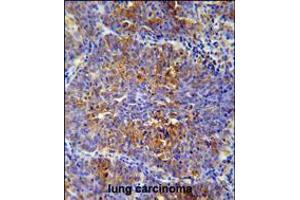 MCAF2 Antibody immunohistochemistry analysis in formalin fixed and paraffin embedded human lung carcinoma followed by peroxidase conjugation of the secondary antibody and DAB staining. (ATF7IP2 抗体  (AA 318-347))