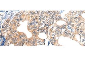 Immunohistochemistry of paraffin-embedded Human gastric cancer tissue using EPHA6 Polyclonal Antibody at dilution of 1:40(x200) (EPH Receptor A6 抗体)